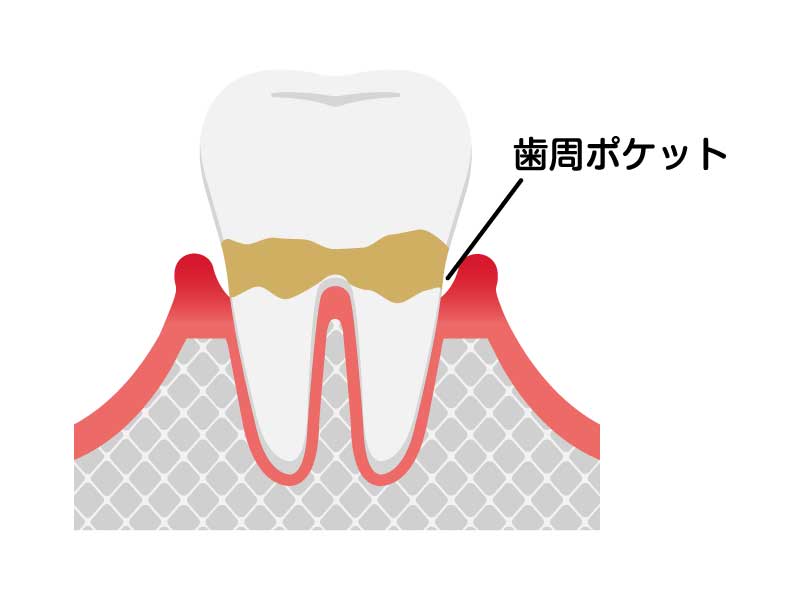 歯周炎（軽度）
