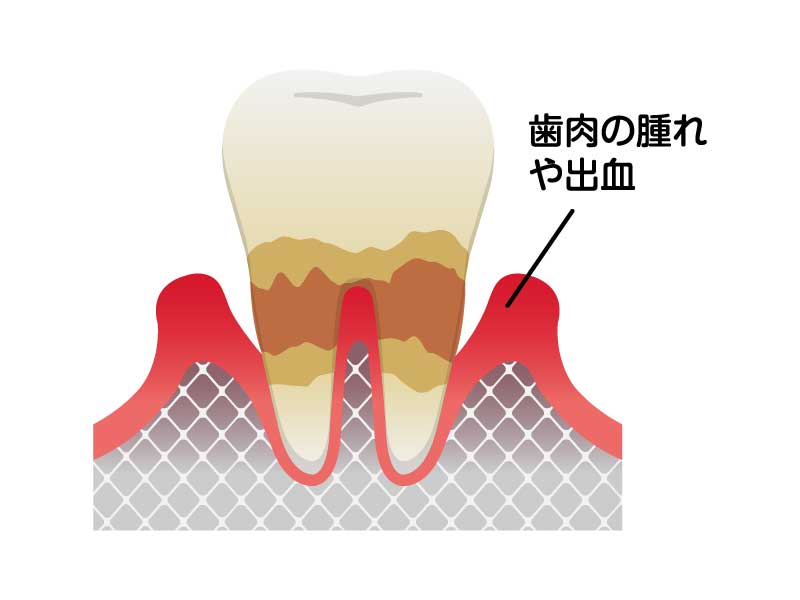 歯周炎（中度）