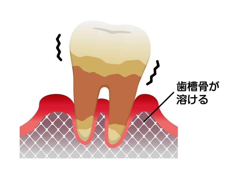 歯周炎（重度）